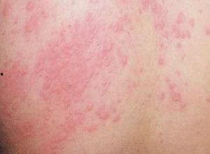 湿疹可以吃八棱瓜吗吗,湿疹患者可适量食用八棱瓜