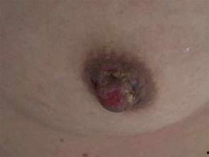 湿疹可以吃八棱瓜吗吗,湿疹患者可适量食用八棱瓜