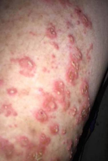 湿疹可以吃八棱瓜吗吗,湿疹患者可适量食用八棱瓜