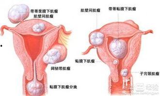 有子宫肌瘤可以吃凉瓜,助调养身体