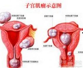 有子宫肌瘤可以吃凉瓜,助调养身体