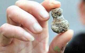 肾结石可以吃土瓜,天然食材的神奇疗效