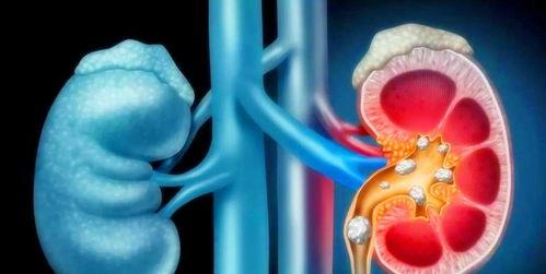 肾结石可以吃土瓜,天然食材的神奇疗效